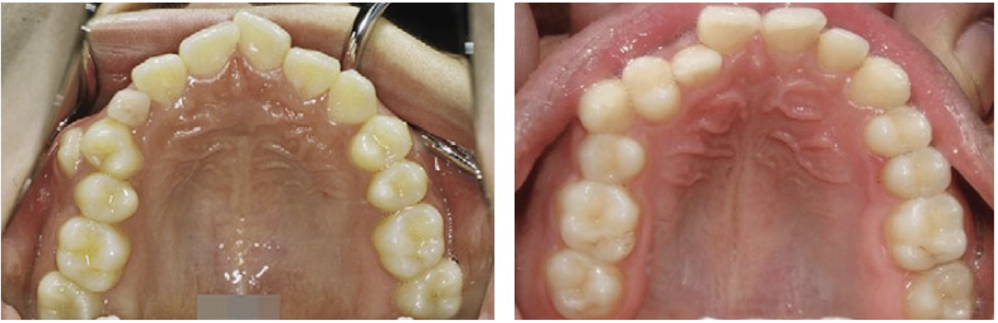 Unlocking the Mystery of Transposed Teeth